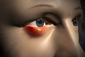 Как лечить ячмень на глазу: как избавиться от недуга быстро