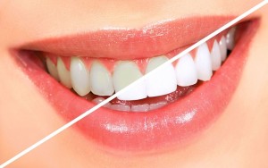 Как отбелить зубы в домашних условиях: 5 очень простых советов