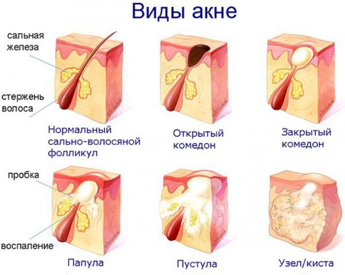 как избавиться от большого прыща на лбу
