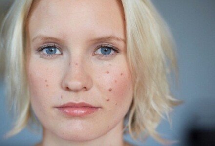 7 Средств И Способов, Как Избавиться От Прыщей За Неделю